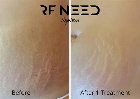 Nude girks with stretch marks pictures. .  <a href=https://redlg.ru/bi...