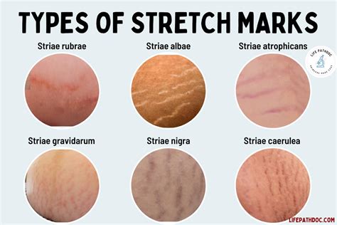 Nude teens with stretch marks.  Stretch marks are a normal part of pube...