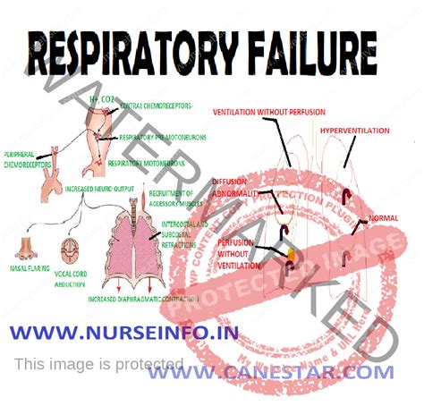 Nursing for Life on LinkedIn: Respiratory failure is a clinical ...