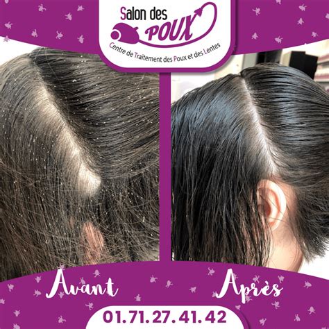 Nymphe poux apres traitement.  D&eacute;couvrez le cycle de vie des poux, leur d&eacute;v...