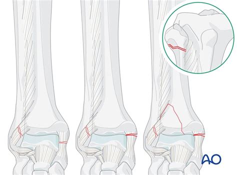 ORIF for Suprasyndesmotic, proximal fibular fracture, …