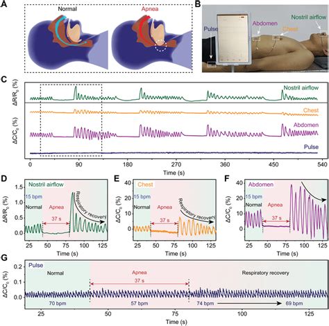 OSAS detecting via simultaneously monitoring four different body parts