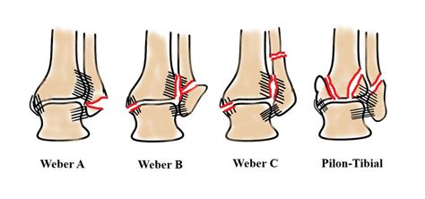 OSG Frakturen Weber B/C: was ist Standard? - Thieme