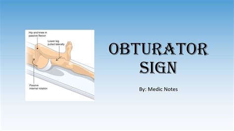 Obturator sign. Obturator sign (internal and external rotation of thigh at hip elicits pain; Peritonitis suggested by: Right heel strike elicits pain; Guarding; Rebound; Rigidity; Clinical Examination Operating Characteristics. Procedure LR+ LR- RLQ pain 7.3-8.4 0-0.28 Rigidity 3.76 0.82 Migration 3.18 0.50 Pain before vomiting 2.76 NA Psoas sign 2.38 