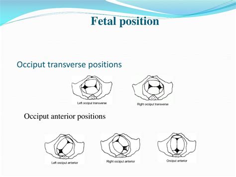 Occiput transverse position UpToDate.