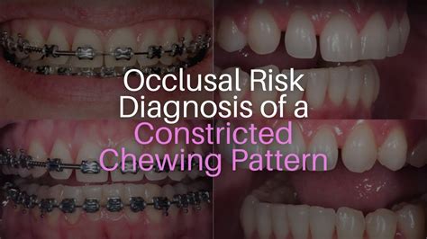 Occlusal Risk Diagnosis of a Constricted Chewing Pattern YouTube