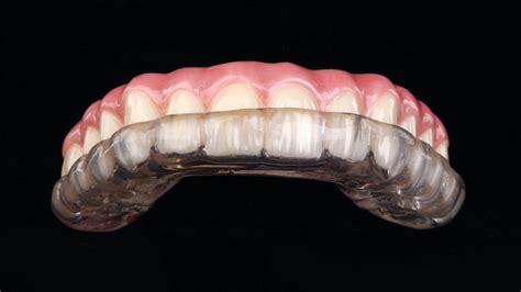 Occlusal guard narrative.  Occlusal guards intended to relieve symptom...