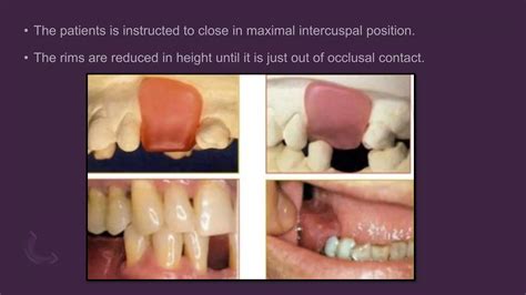 Occlusal relationship in removable partial denture.  Find 96,177 3d Realistic Render White Den...