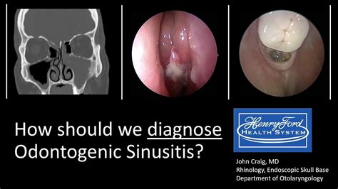 Odontogenic sinusitis: causes, diagnosis and treatment