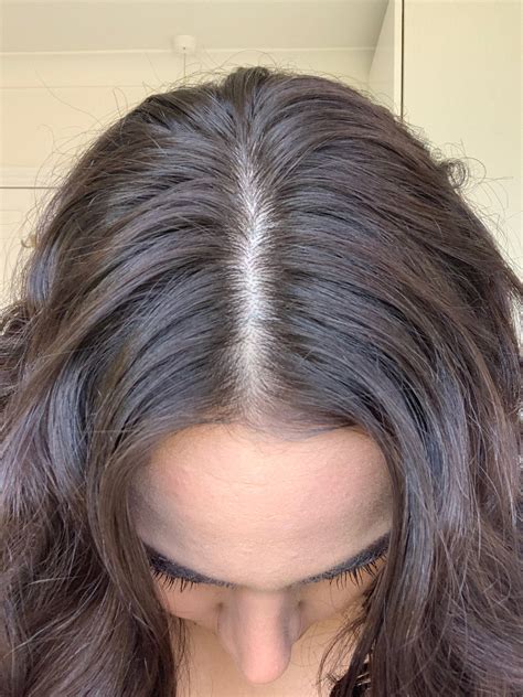 Oily Scalp Hair Loss: Are The Two Connected?