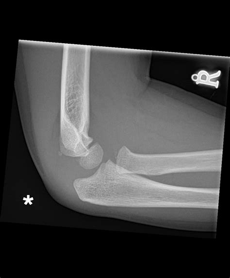 Twenty-two patients with a total of 23 fractures of the olecranon were reviewed after an average period of 26 months (range 5-96 months). All fractures were either comminuted, transverse or oblique fractures with separation of the fragments and all were treated without operation by early active mobilization within 10 days of fracture.. 