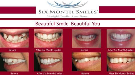  The Six Month Smiles® guided orthodontic system equips you to help your adult patients with crooked teeth, spaced cases, crowded cases, rotations, deep bites, creating spaces for implants and setting up cosmetic cases utilizing Clear Braces or Aligners. Your production will increase as you change lives. . 