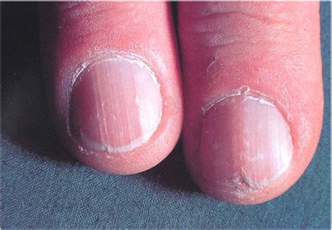 Oct 1, 2022 · L60.3 is a valid billable ICD-10 diagnosis code for Nail dystrophy . It is found in the 2022 version of the ICD-10 Clinical Modification (CM) and can be used in all HIPAA-covered transactions from Oct 01, 2021 - Sep 30, 2022 . ↓ See below for any exclusions, inclusions or special notations. The use of ICD-10 code L60.3 can also apply to: . 