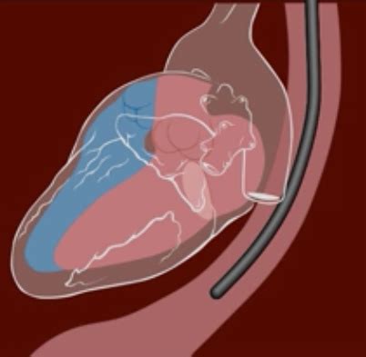 Open Anesthesia - June 2024 TEE Rounds Now Available: LVAD.