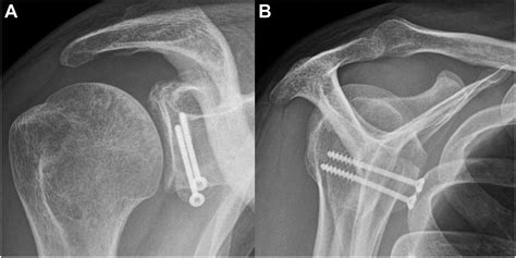 Open Latarjet-Patte Procedure for Anterior Shoulder …