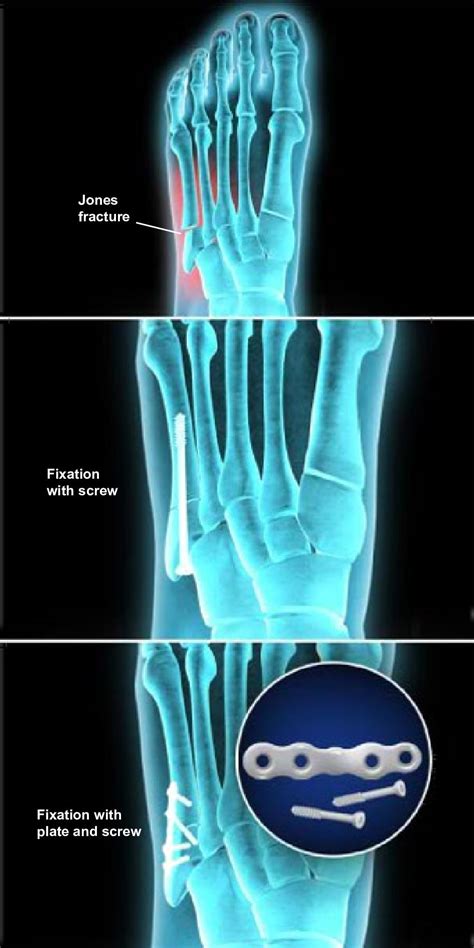 Open Reduction and Internal Fixation of Jones Fractures