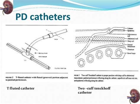 Open Revision of a PD Catheter Medical Billing and …