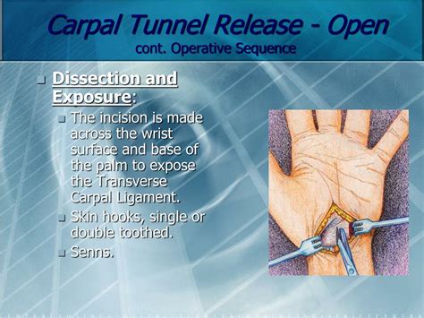 Apr 22, 2013 · This video portrays the open carpal tunnel release. Principle points of this surgical technique include an incision ulnar to the thenar crease. This prevents injury to palmar cutaneous branch of the median nerve. In addition, division of the transverse carpal ligament ulnar to the median nerve prevents scarring directly over the nerve. . 