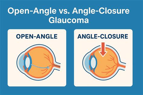 Open vision vs closed vision.  Closed Angle Glaucoma: Key Differences Glaucoma is a...