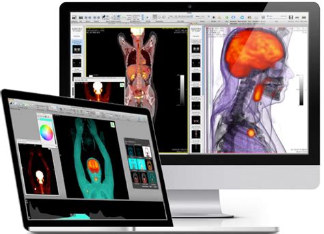 Open-source software in medical imaging: development of OsiriX