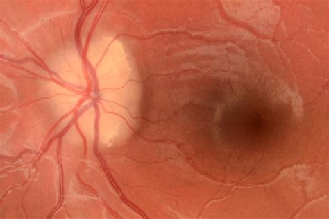 Optic Disc Drusen (Pseudopapilledema) Clinical …