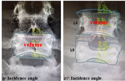 Optimum Angle of Incidence for General Anteroposterior …