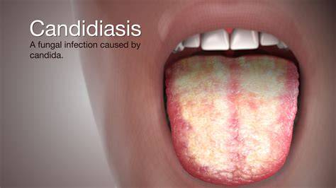 Oral Candidiasis