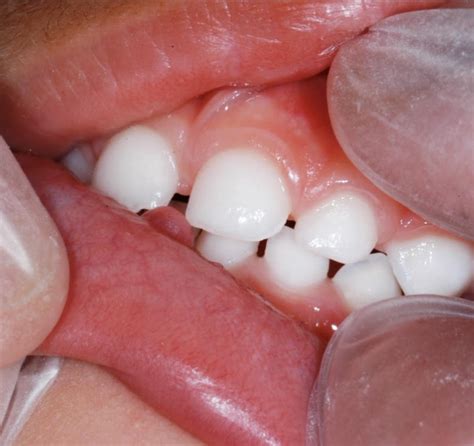 Oral Mucocele Condition, Treatments and Pictures for Children