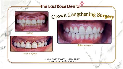 Oral crown picture. .  ...