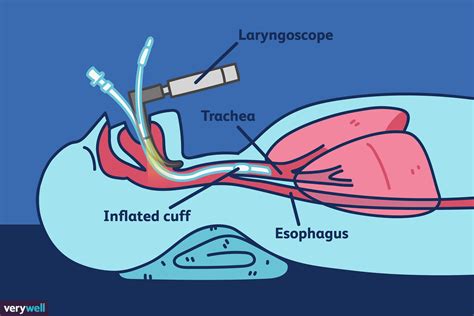 Oral intubation definition of oral intubation by Medical dictionary