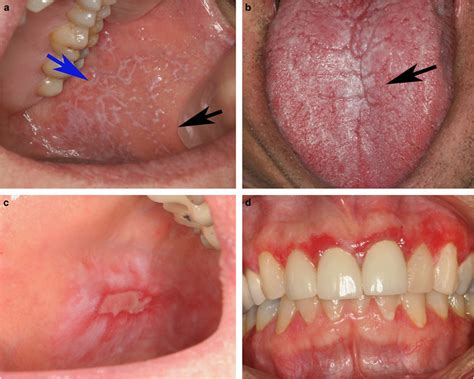 Oral lichenoid lesions: distinguishing the benign from the …