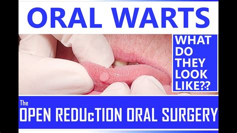 Oral warts pics. .  <a href=https://www.info.dev-nanuk.com/.well-known/pki-validation/...