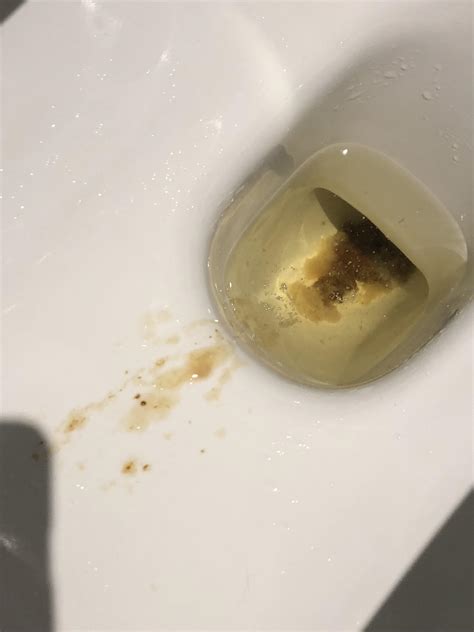 Orange liquid when pooping. Hi everyone! I wanted to talk about my poop. I’ve been pooping out orange oil the past few days, sometimes when I poop, other times just when I sit down to pee. I’ve been taking mesalamine suppositories for 2 months now but I don’t think it’s them, because they would usually just be like a whitish liquid. 