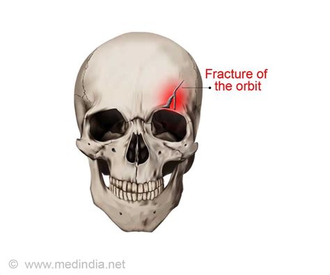 Orbital Socket Fractures: How to Identify and Treat Them