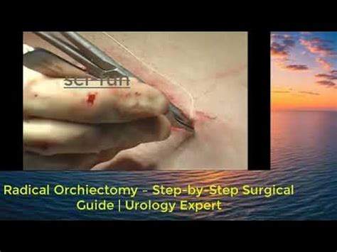 Orchiectomy for transgender.  In this technique, a vaginal vault is created be...