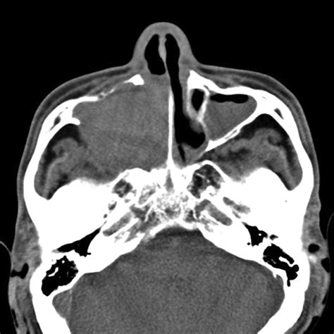 Organized Hematoma of the Maxillary Sinus: CT Findings