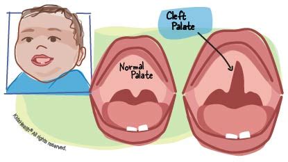 Orofacial Clefts (for Parents) - Nemours KidsHealth