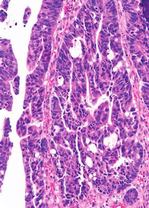 Orphanet: Intraductal papillary mucinous carcinoma of …