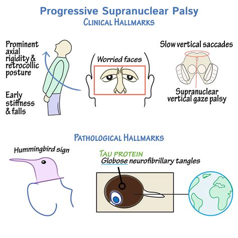 Orphanet: Progressive supranuclear palsy pure akinesia with gait ...