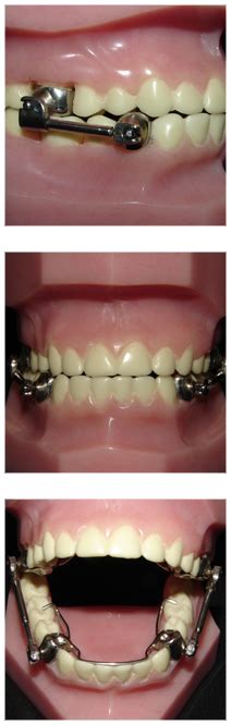 Orthodontic Appliances - Goldreich Orthodontics