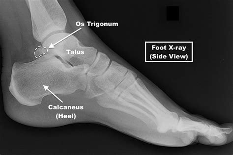 Os Trigonum Syndrome in Children and Teens Children