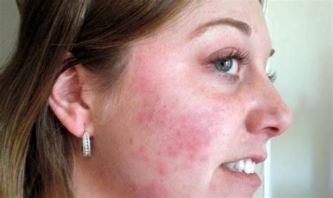 Osip na vratu kod odraslih. .  ...