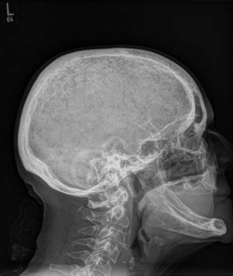 Osseous abnormality. Common skeletal abnormalities noted in NF1 include long bone dysplasia resulting in fractures and non-union, sphenoid wing dysplasia and scoliosis . Low BMD and higher rates of fractures have been described in patients with and without osseous defects [ 60 ]. 