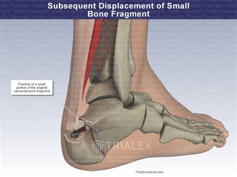 Osseous fragment.  Understanding Bone Fragments A bone fragment is a de...