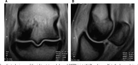 Osseous lesions in the metacarpo(tarso)phalangeal joint