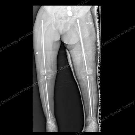 Osteogenesis Imperfecta: Approaches for Treating Children