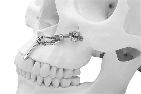 Osteogenetic distractors for maxillo-facial surgery Cizeta Surgical