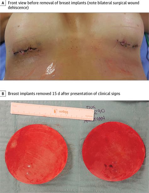 Badwap Son And Mother And Daughter - th?q=Osteomyelitis after breast augmentation