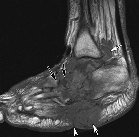 ICD-10 Code E10.52 Type 1 diabetes mellitus with diabetic peripheral angiopathy with gangrene ... Other acute osteomyelitis, right ankle and foot M86.261 Subacute osteomyelitis, right tibia and fibula M86.262 Subacute osteomyelitis, left …. 