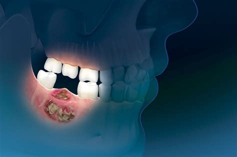 Osteonecrosis Of The Jaw And Bisphosphonates - Putting The Risk In …